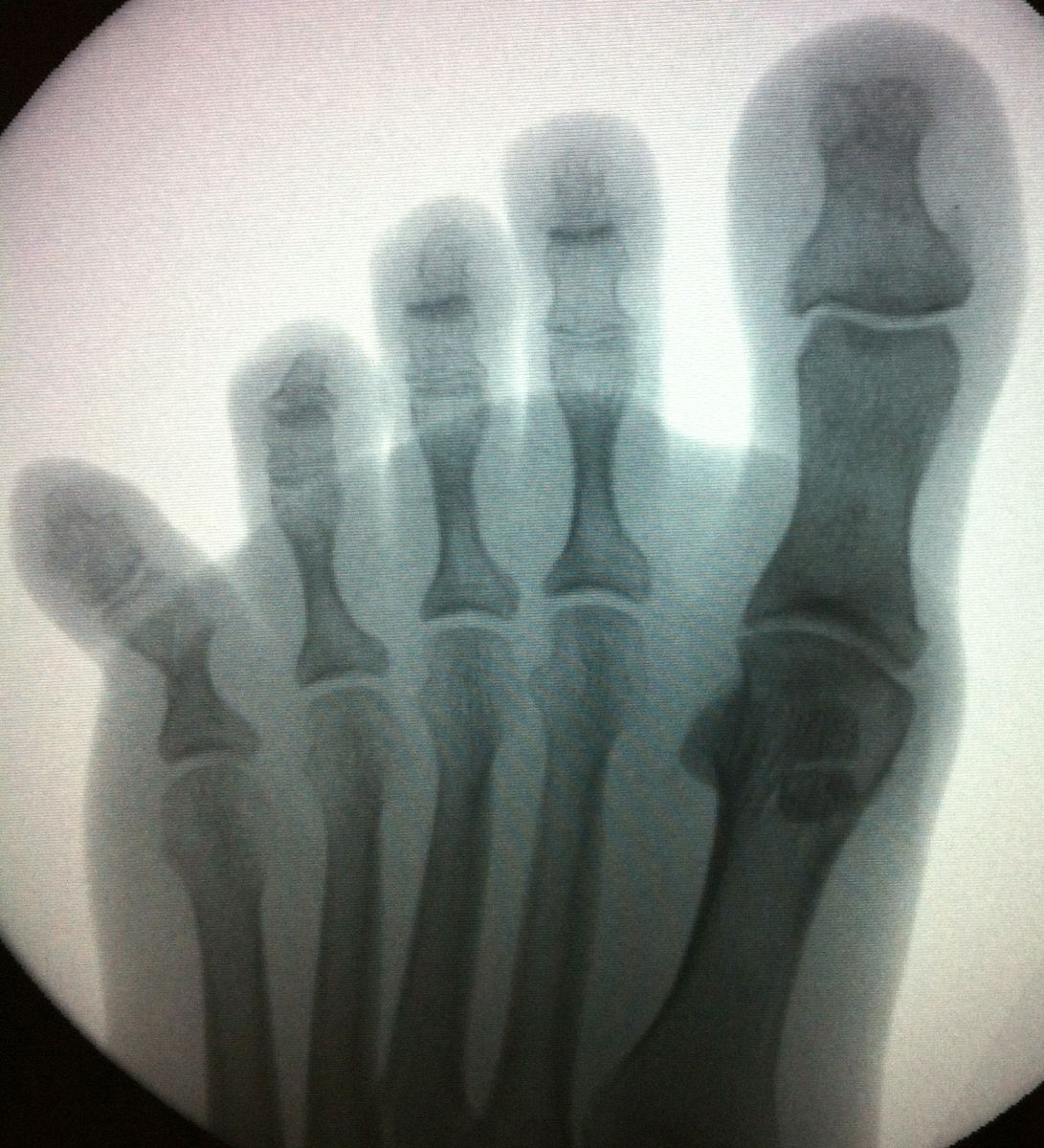 Ногтевой фаланги пальца ноги. Оскольчатый перелом пальца ноги рентген. Перелом фаланги пальца стопы рентген. Перелом основной фаланги 5 пальца ноги рентген. Перелом фаланги 5 пальца стопы рентген.
